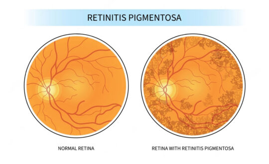 Retinitis_Pigmentosa