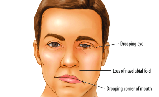 bell's palsy