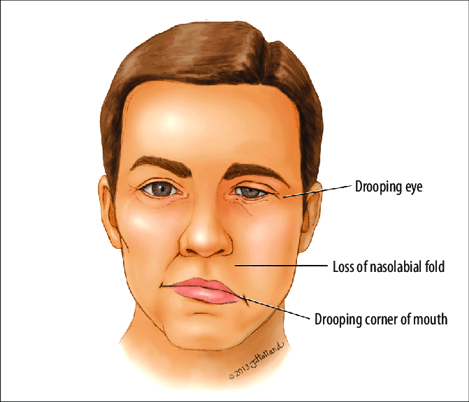 bell's palsy