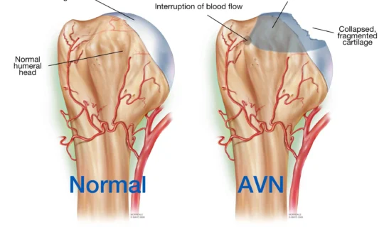 avascular-necrosis-happens.jpg